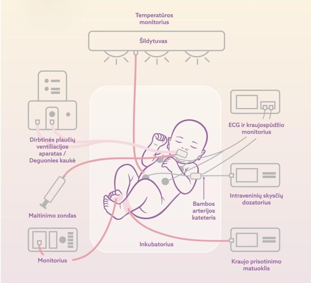 Newborn in a transparent incubator connected to multiple monitoring and support lines (temperature warmer, IV fluids, feeding tube, and respiratory/ECG monitors).